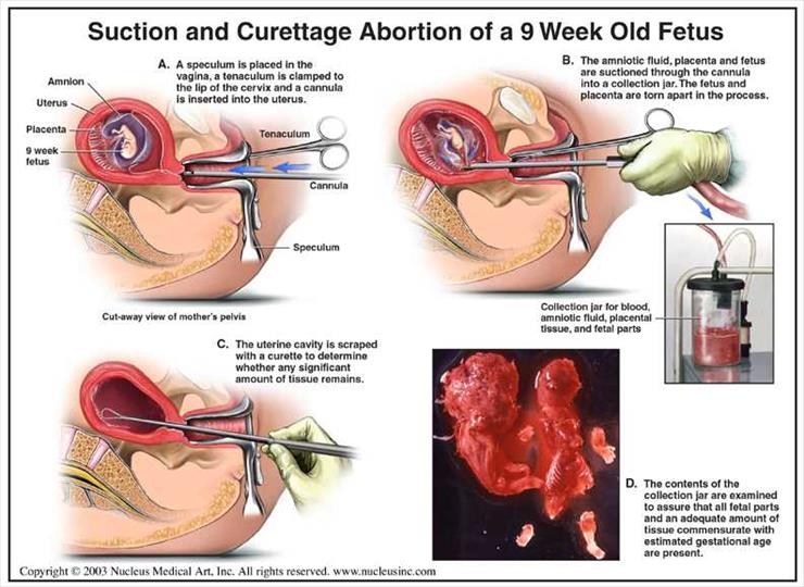 Aborcja - aborcja-antyaborcja-00100.jpg